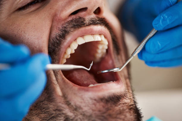 Best Emergency Treatment for Toothache in San Anselmo, CA